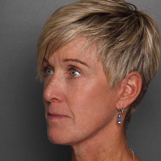 face lift after